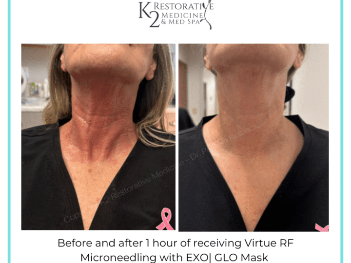 Before-and-after-1-hour-of-receiving-Virtue-RF-Microneedling-with-EXO-GLO-Mask