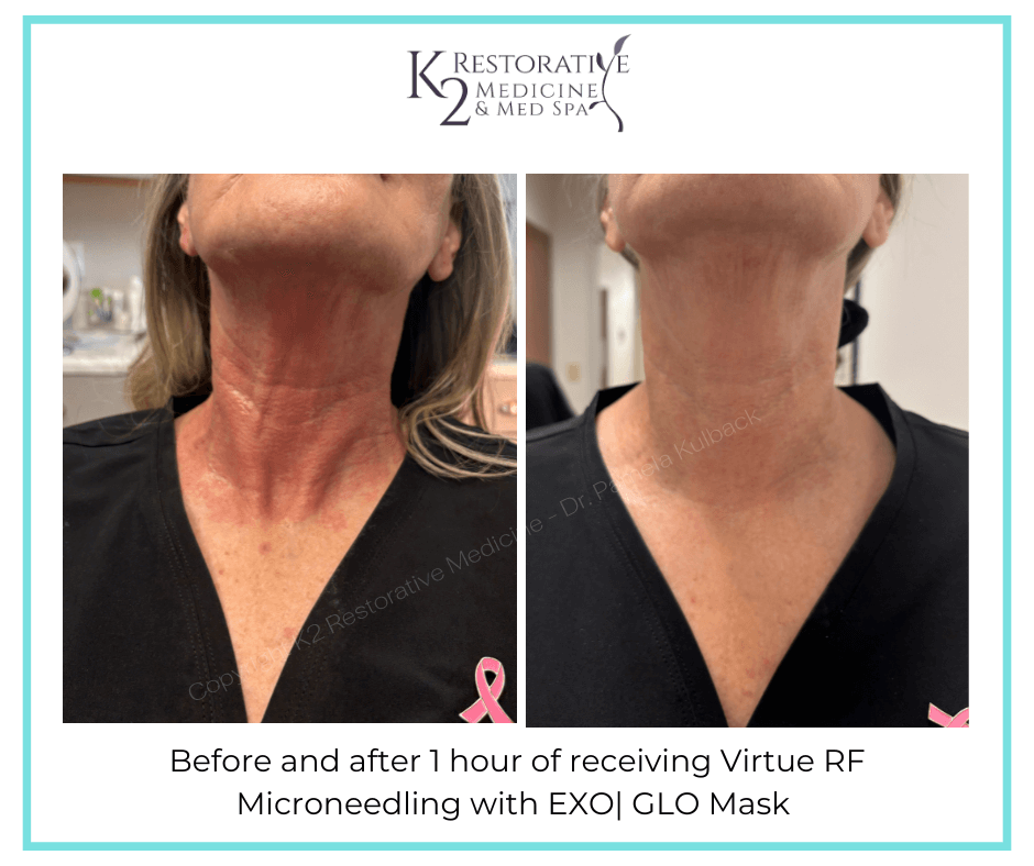 Before-and-after-1-hour-of-receiving-Virtue-RF-Microneedling-with-EXO-GLO-Mask