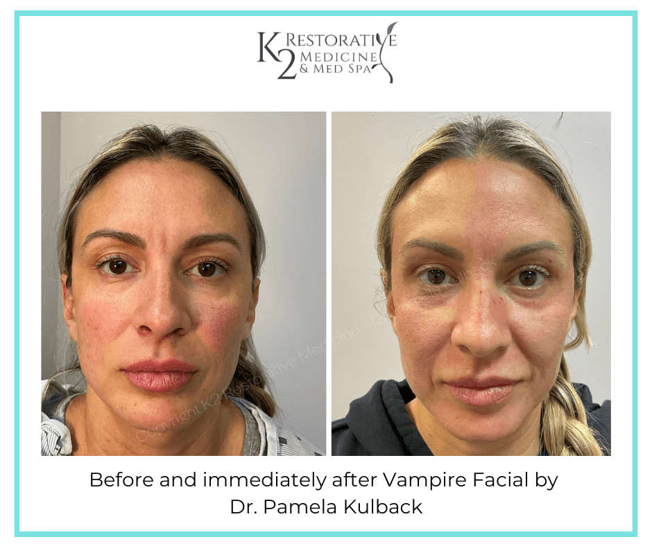 Before and immediately after Vampire Facial (2) Before and immediately after Vampire Facial by Dr Pamela Kulback