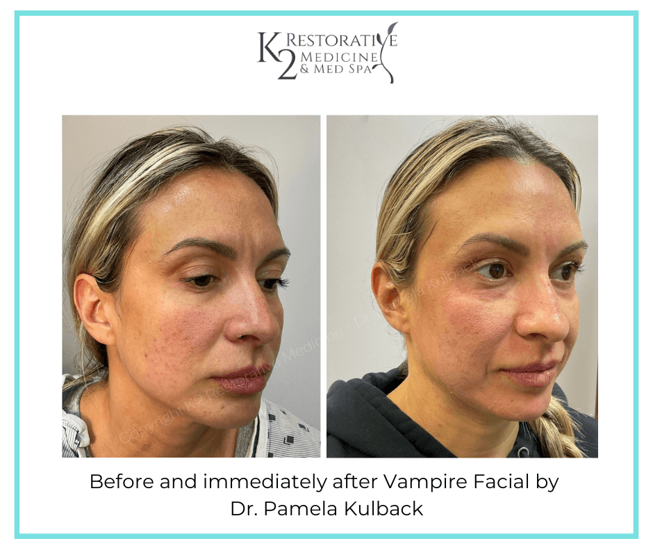 Before and immediately after Vampire Facial (3) Before and immediately after Vampire Facial by Dr Pamela Kulback