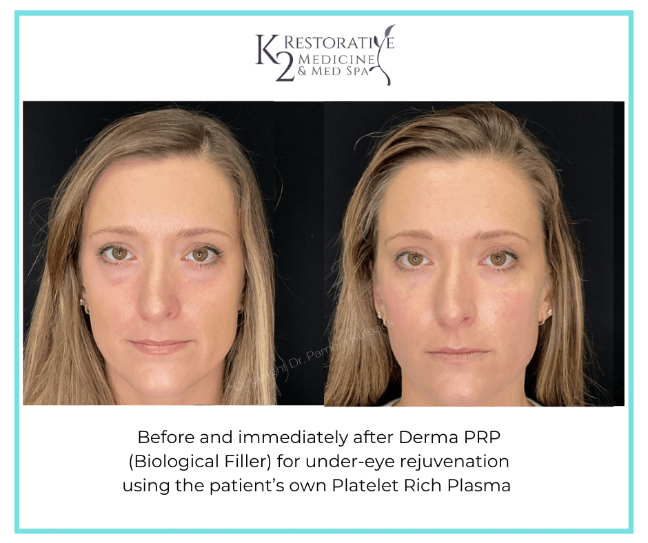 Before and immediately after Derma PRP by Dr Pamela Kulback (2) Before and immediately after Derma PRP by Dr Pamela Kulback at K2 Restorative Medicine and Med Spa