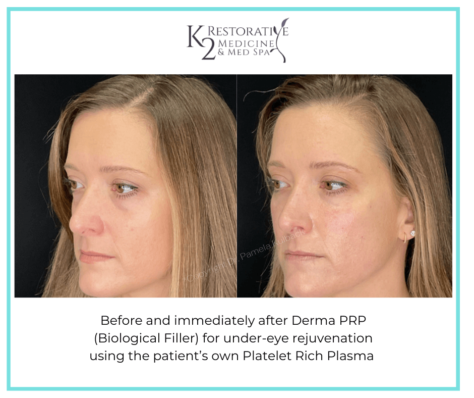 Before and immediately after Derma PRP by Dr Pamela Kulback (3) Before and immediately after Derma PRP by Dr Pamela Kulback at K2 Restorative Medicine and Med Spa
