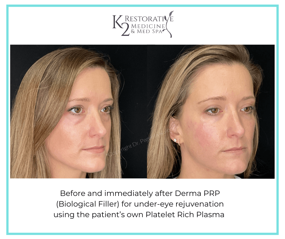 Before and immediately after Derma PRP by Dr Pamela Kulback Before and immediately after Derma PRP by Dr Pamela Kulback at K2 Restorative Medicine and Med Spa