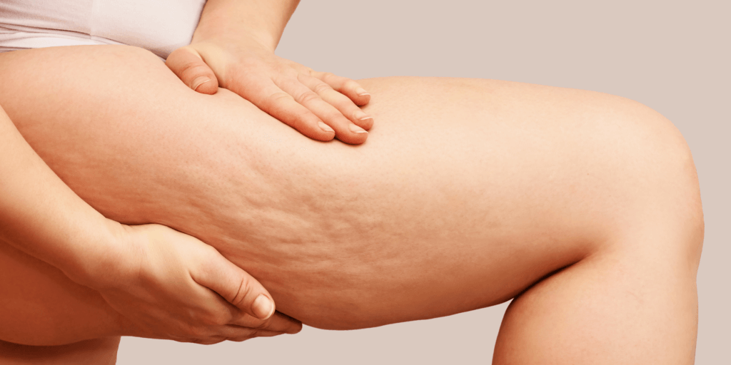 Unwanted Fat and Cellulite at K2 restorative Medicine and Med Spa