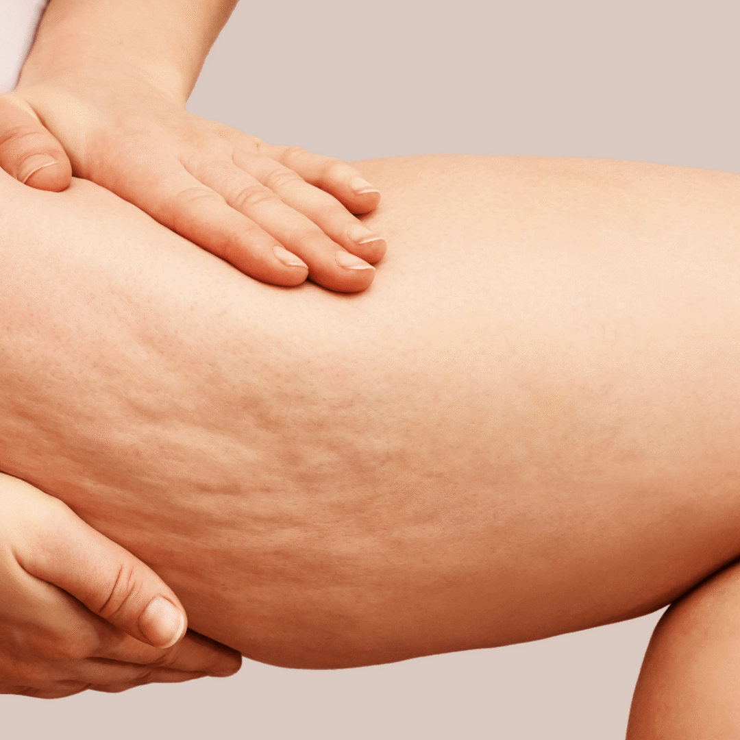 Unwanted Fat and Cellulite at K2 restorative Medicine and Med Spa