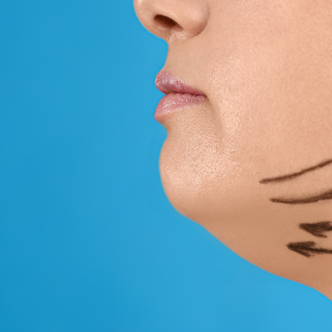 Agnes RF Microneedle in Trussville, AL