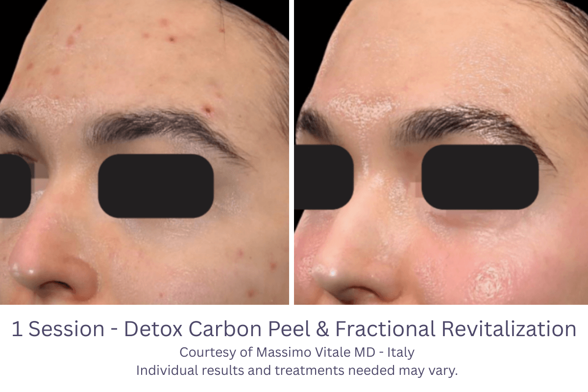 1 Session - Detox Carbon Peel & Fractional Revitalization