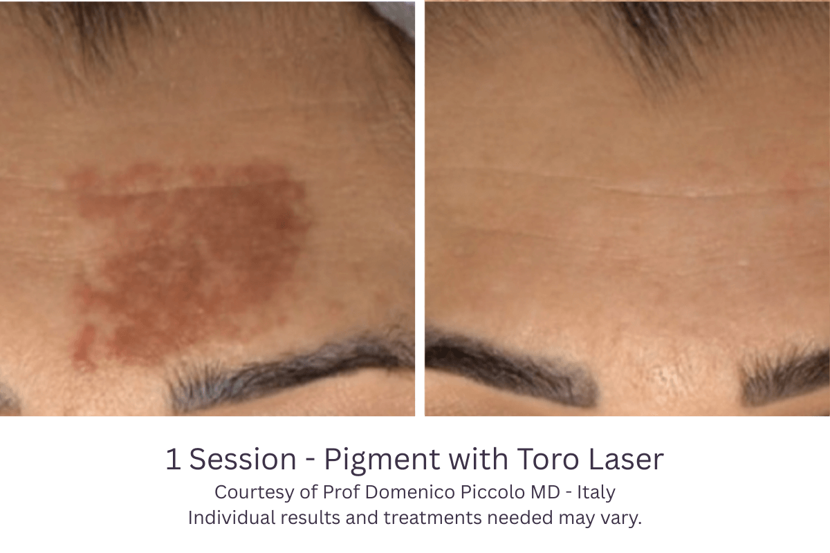 1 Session - Pigment with Toro Laser