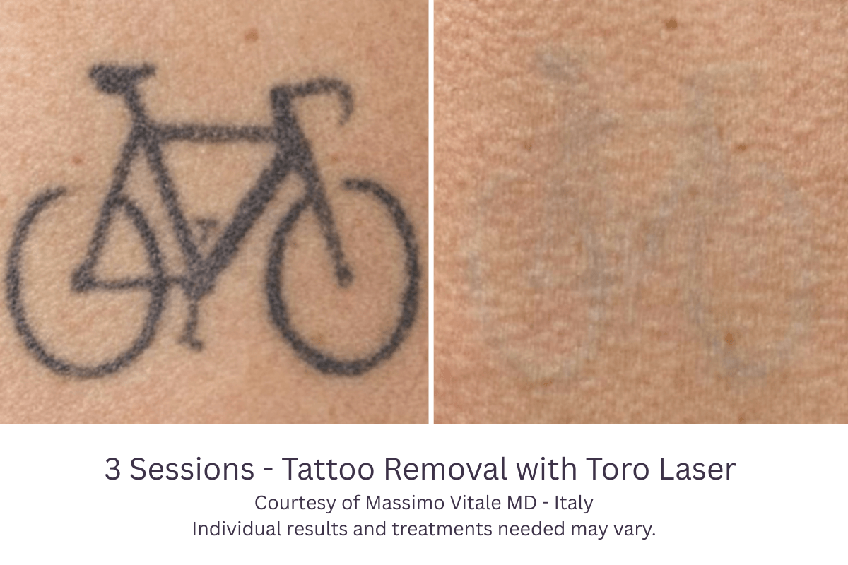 3 Sessions - Tattoo Removal with Toro Laser