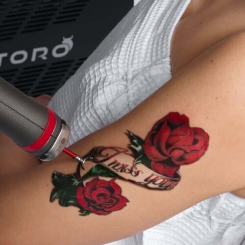 Tattoo Regret - Toro Laser at K2 Medicine in Trussville, AL