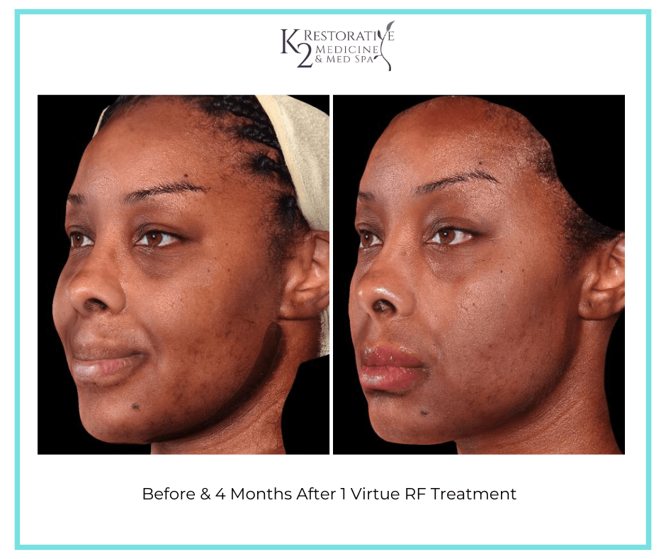 Before & 4 Months After 1 Virtue RF Treatment