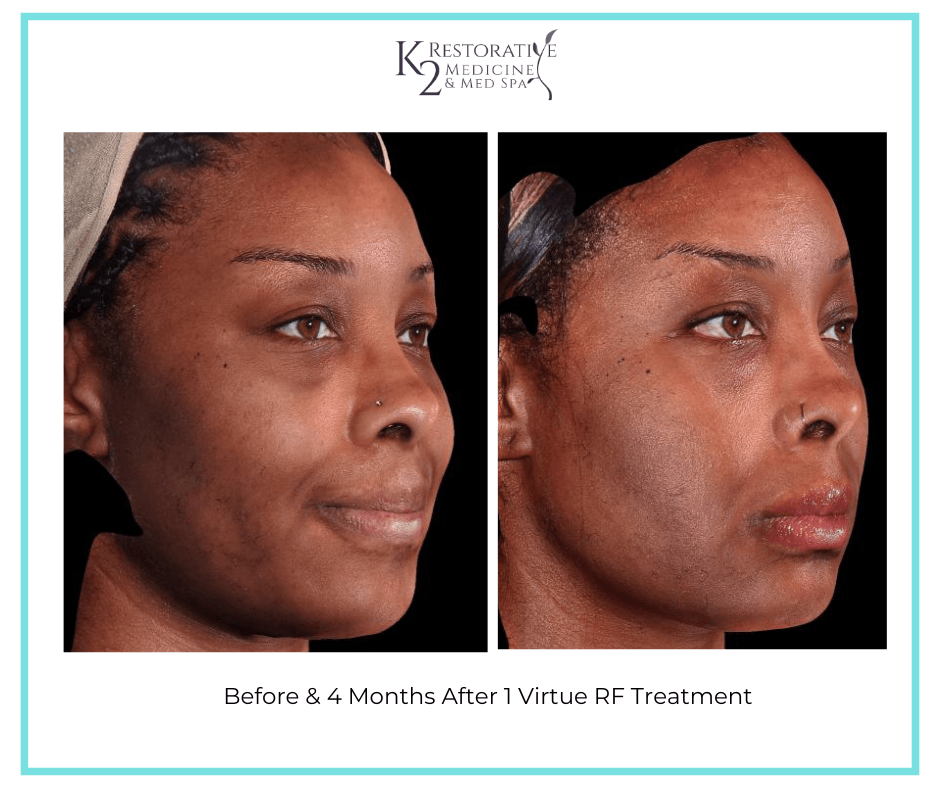 Before & 4 Months After 1 Virtue RF Treatment