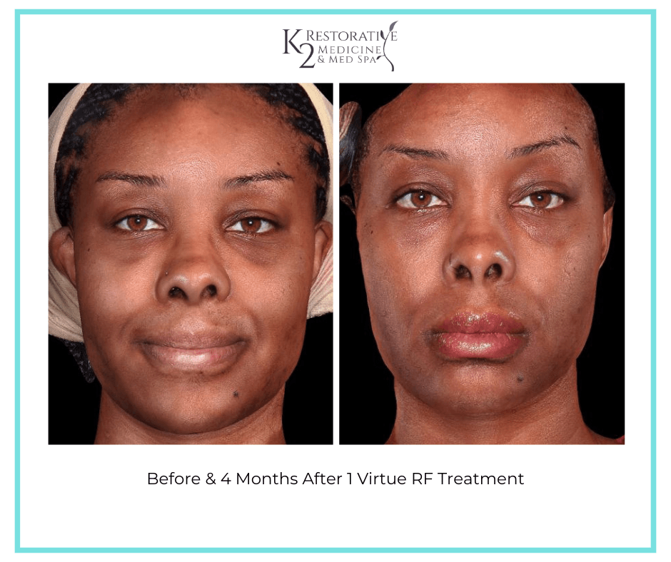 Before & 4 Months After 1 Virtue RF Treatment