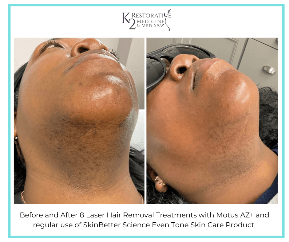 Before and After 8 Laser Hair Removal treatments + SkinBetter Science Even Tone Product Before and After 8 Laser Hair Removal treatments + SkinBetter Science Even Tone Product