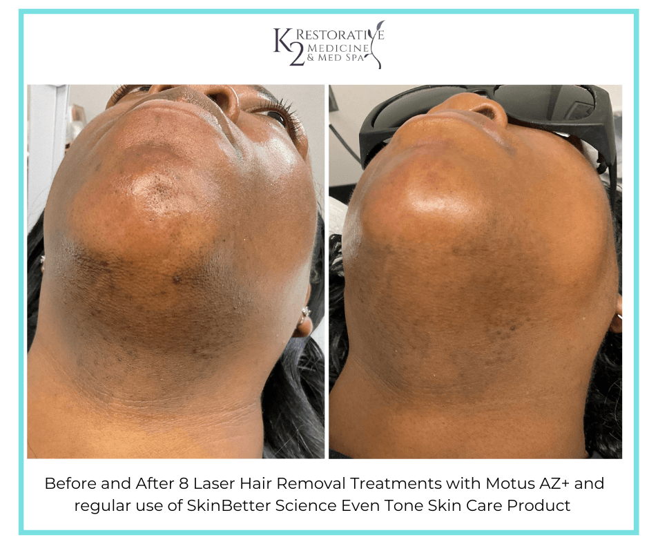 Before and After 8 Laser Hair Removal treatments + SkinBetter Science Even Tone Product Before and After 8 Laser Hair Removal treatments + SkinBetter Science Even Tone Product