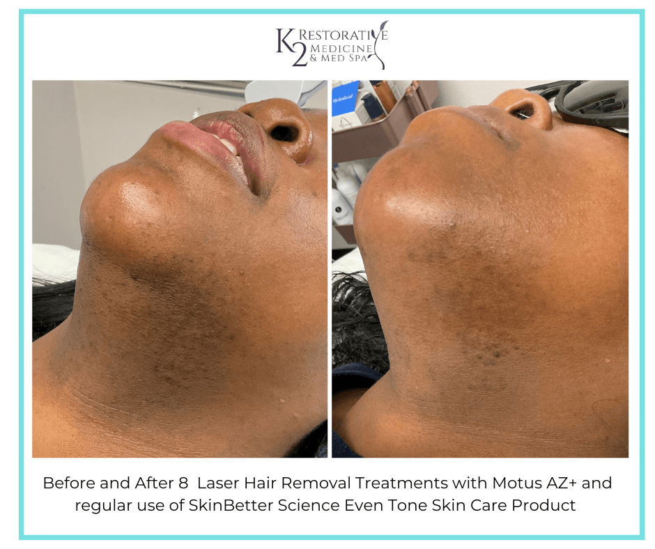 Before and After 8 Laser Hair Removal treatments + SkinBetter Science Even Tone Product Before and After 8 Laser Hair Removal treatments + SkinBetter Science Even Tone Product