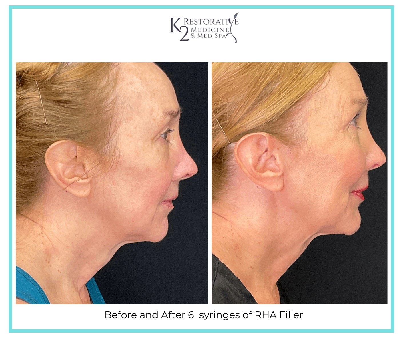 Before and After 6 syringes of RHA Filler (2) Before and After 6 syringes of RHA Filler