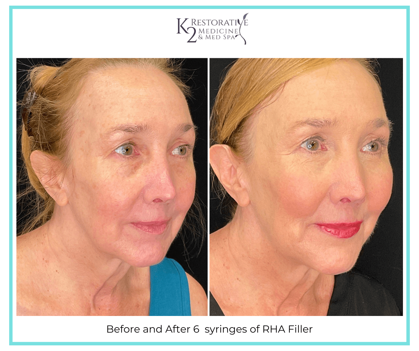 Before and After 6 syringes of RHA Filler