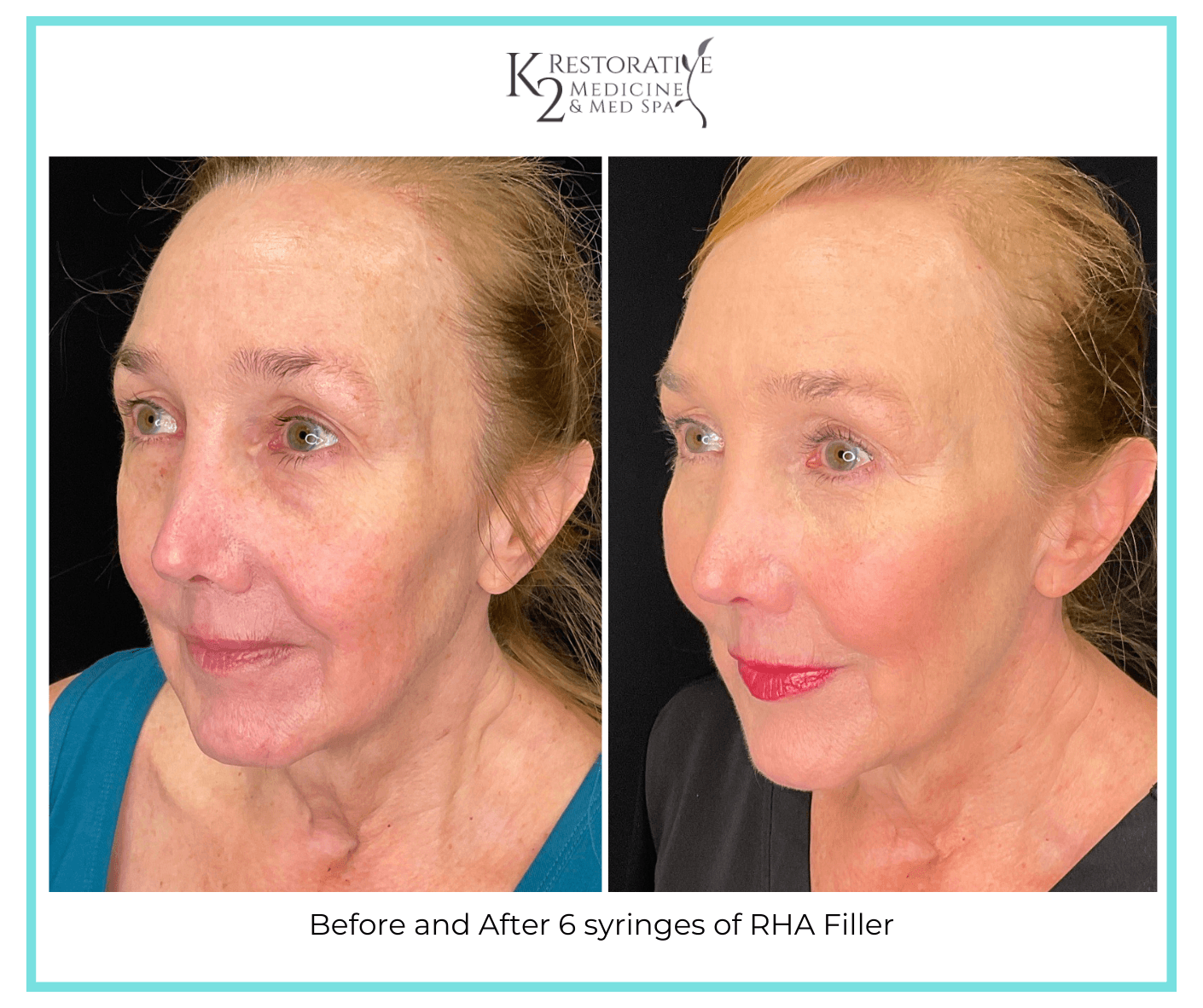 Before and After 6 syringes of RHA Filler (4) Before and After 6 syringes of RHA Filler