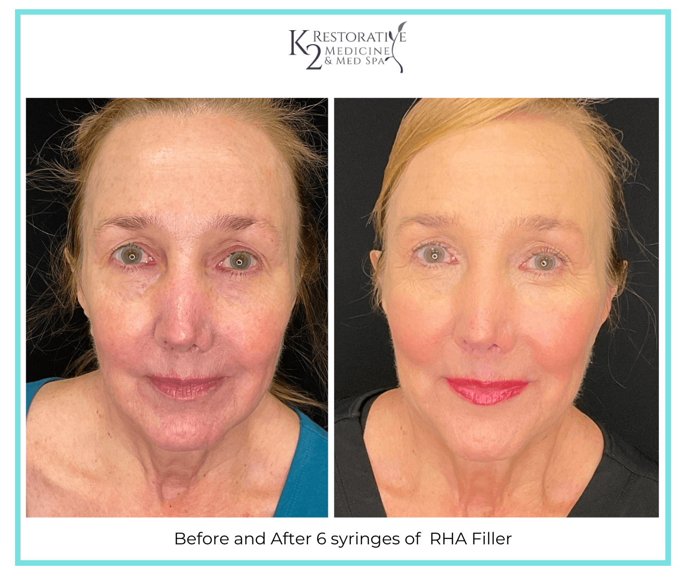 Before and After 6 syringes of RHA Filler (5) Before and After 6 syringes of RHA Filler