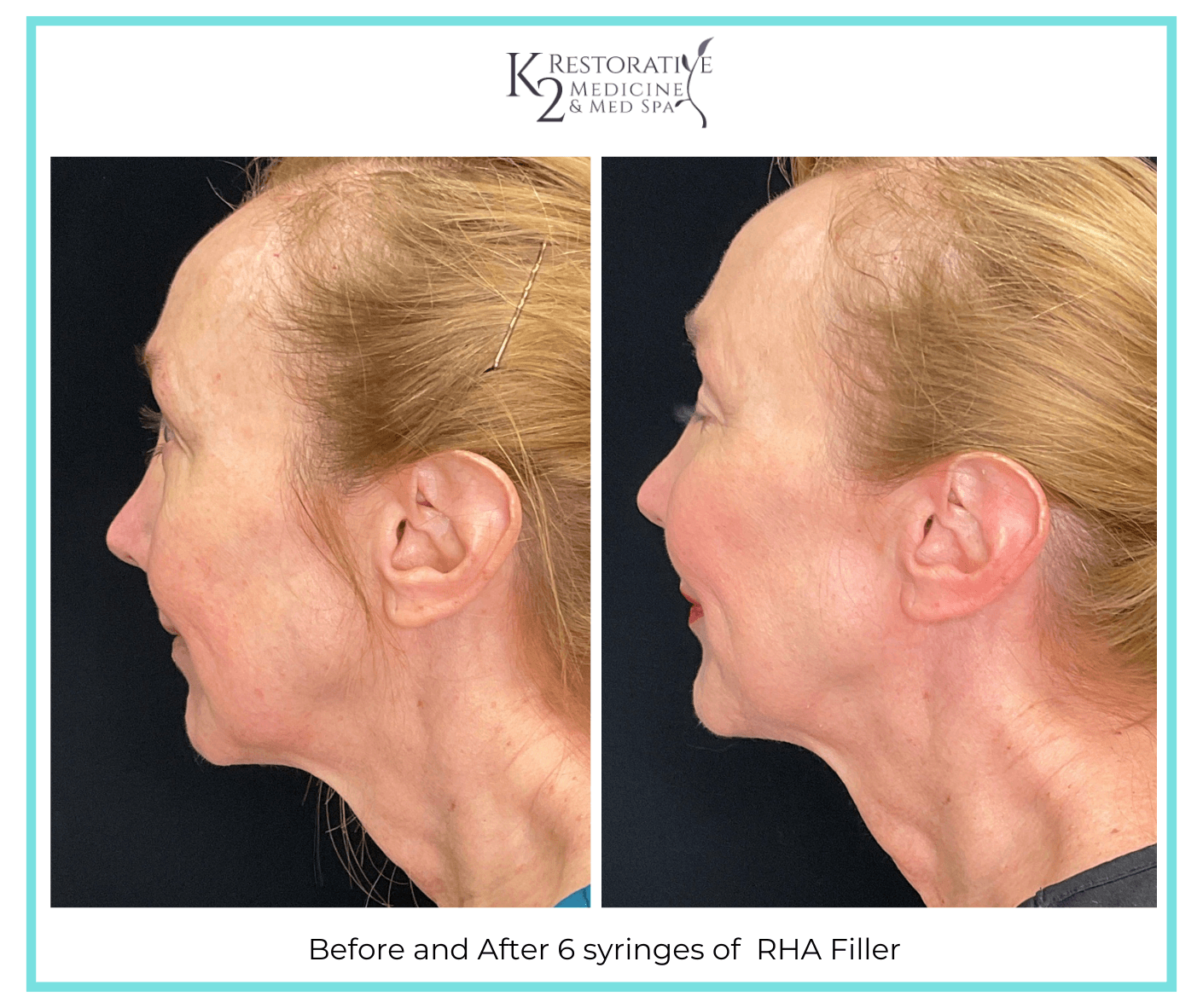 Before and After 6 syringes of RHA Filler Before and After 6 syringes of RHA Filler
