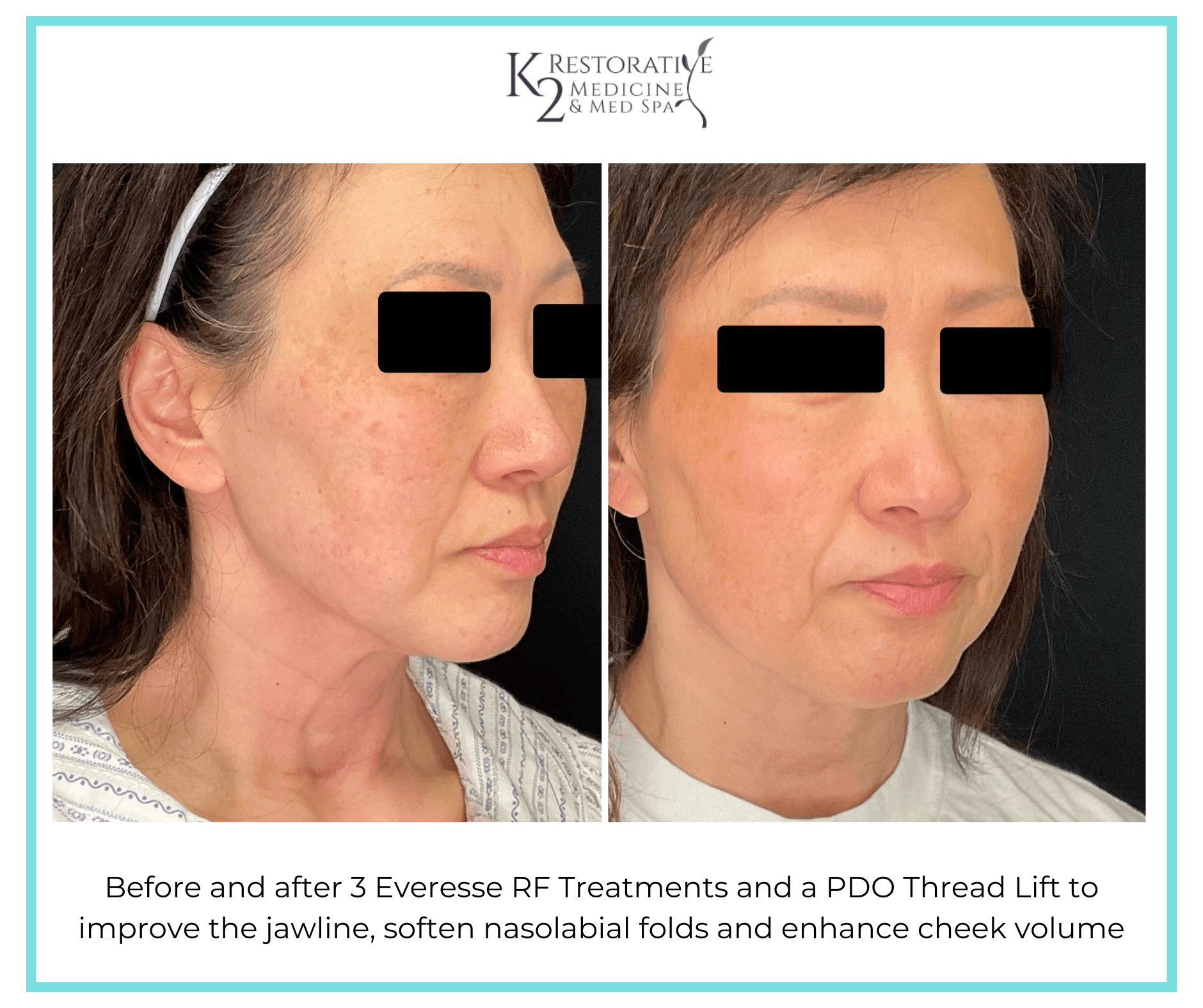 Before and after 3 Everesse RF Treatments and a PDO Thread Lift to improve the jawline, soften nasolabial folds and enhance cheek volume