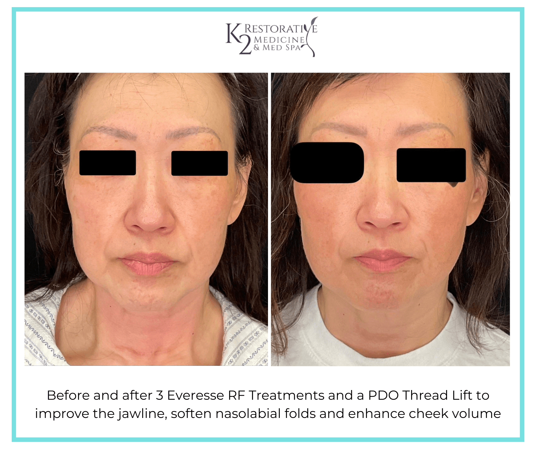 Before and after 3 Everesse RF Treatments and a PDO Thread Lift to improve the jawline, soften nasolabial folds and enhance cheek volume