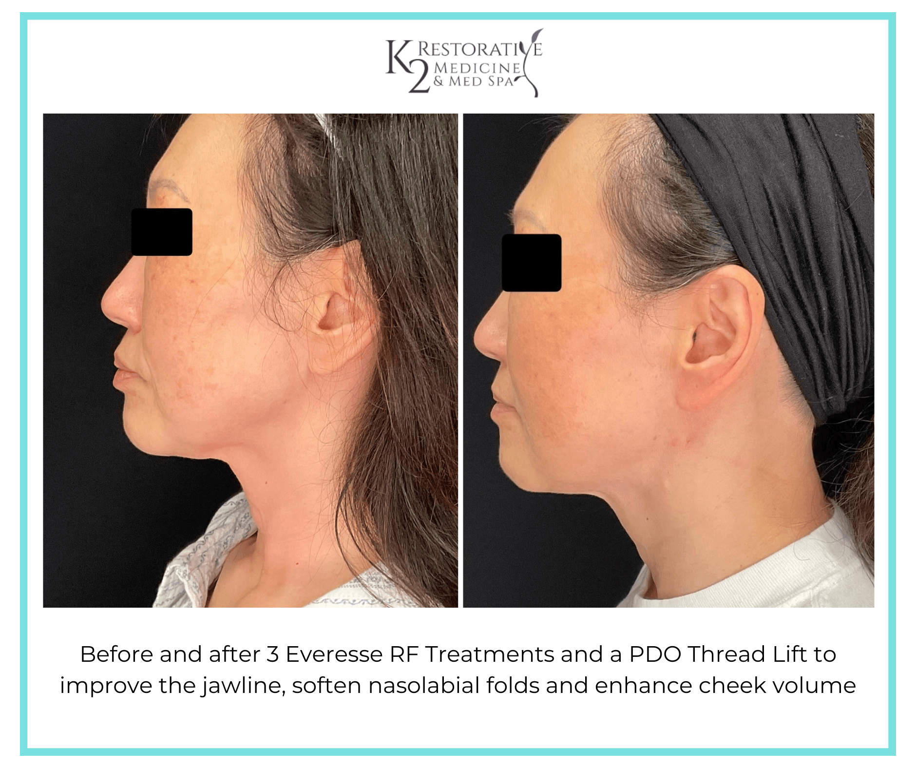 Before and after 3 Everesse RF Treatments and a PDO Thread Lift to improve the jawline, soften nasolabial folds and enhance cheek volume