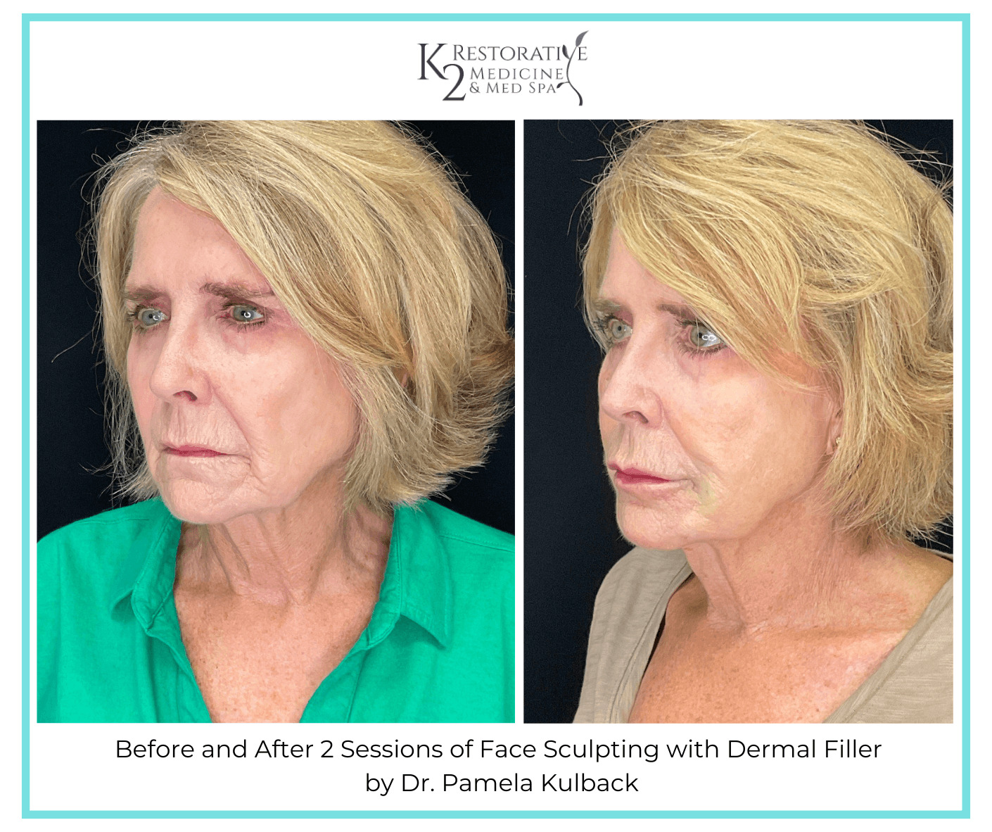 Before and After 2 Sessions of Face Sculpting with Filler by Dr. Pamela Kulback