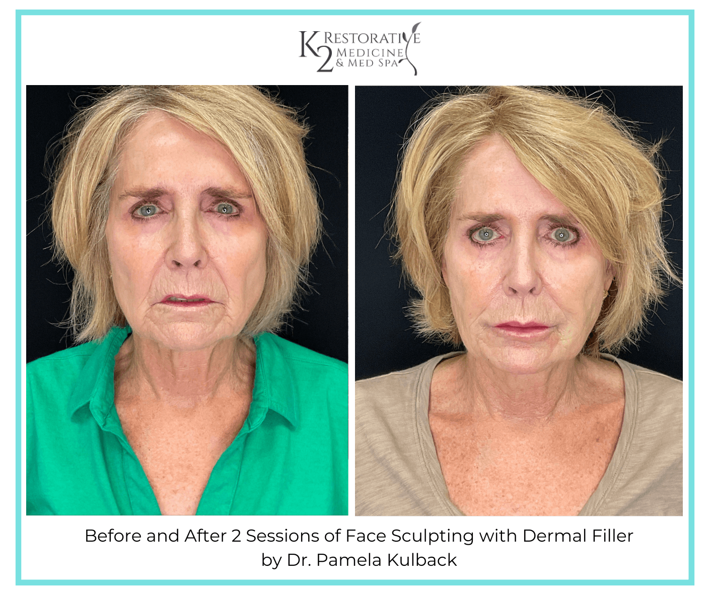 Before and After 2 Sessions of Face Sculpting with Filler by Dr. Pamela Kulback