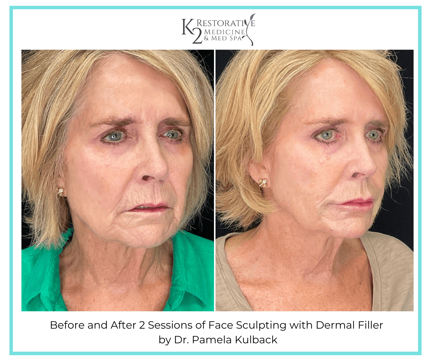 Before and After 2 Sessions of Face Sculpting with Filler by Dr. Pamela Kulback