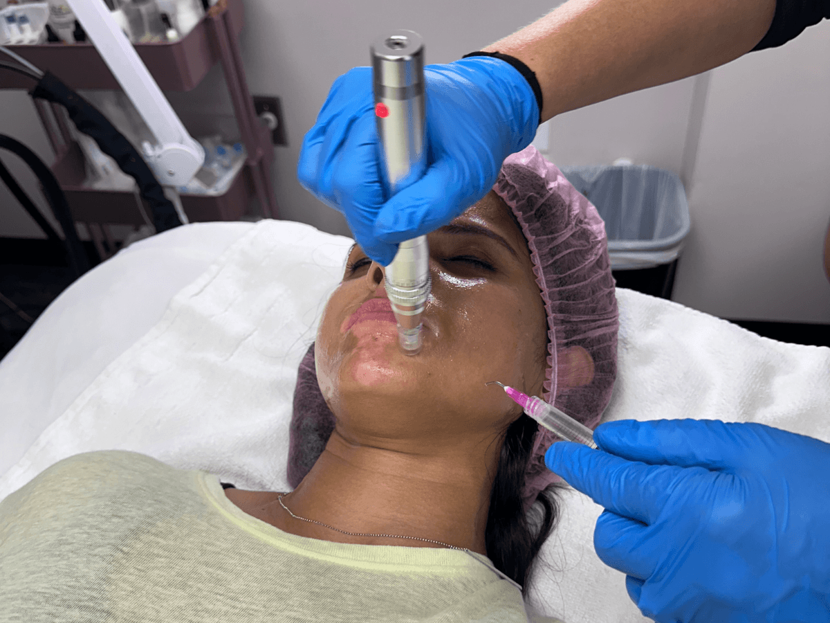 Salmon DNA Mesoneedling at K2 Restorative Medicine and Med Spa
