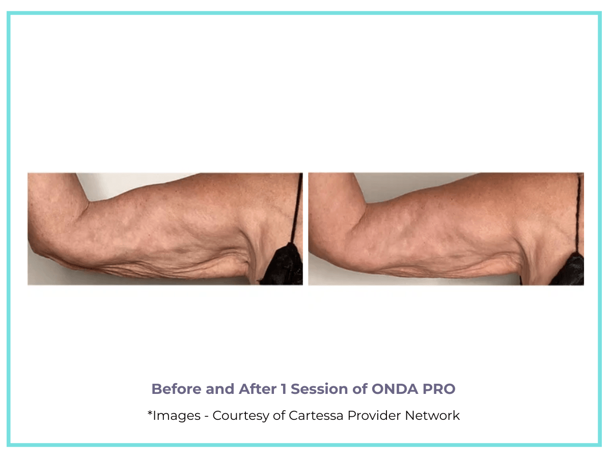 ARM TREATMENT - BEFORE AND AFTER ONDA PRO