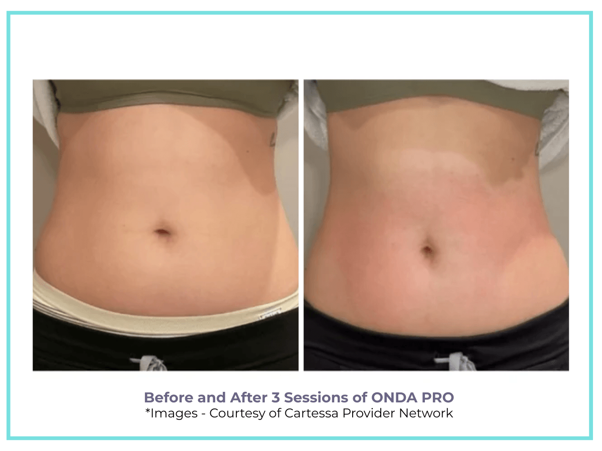 BEFORE AND AFTER ONDE PRO for belly fat