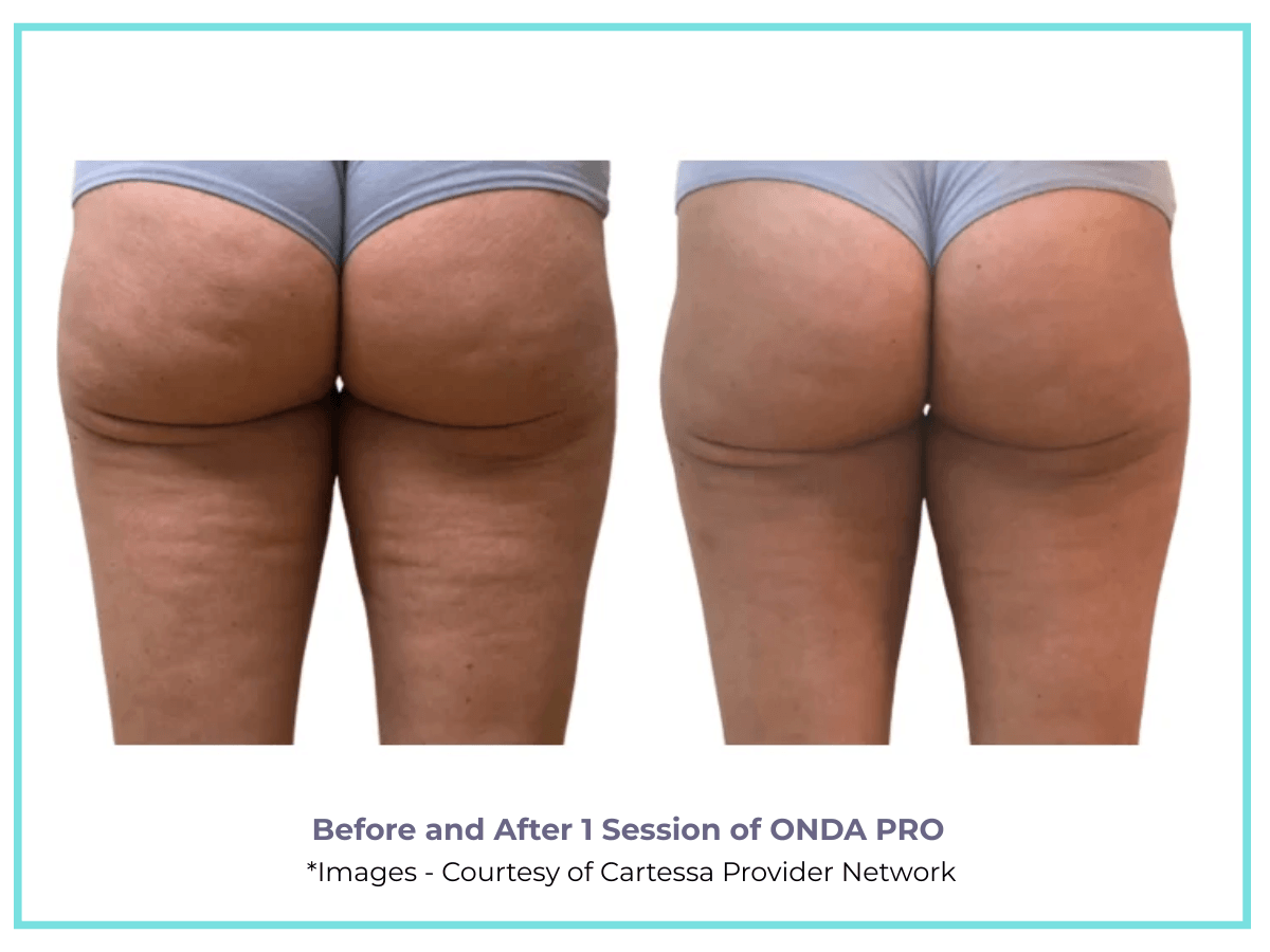 ONDA PRO TREATMENT FOR CELLULITE ON THE BUTTOCKS
