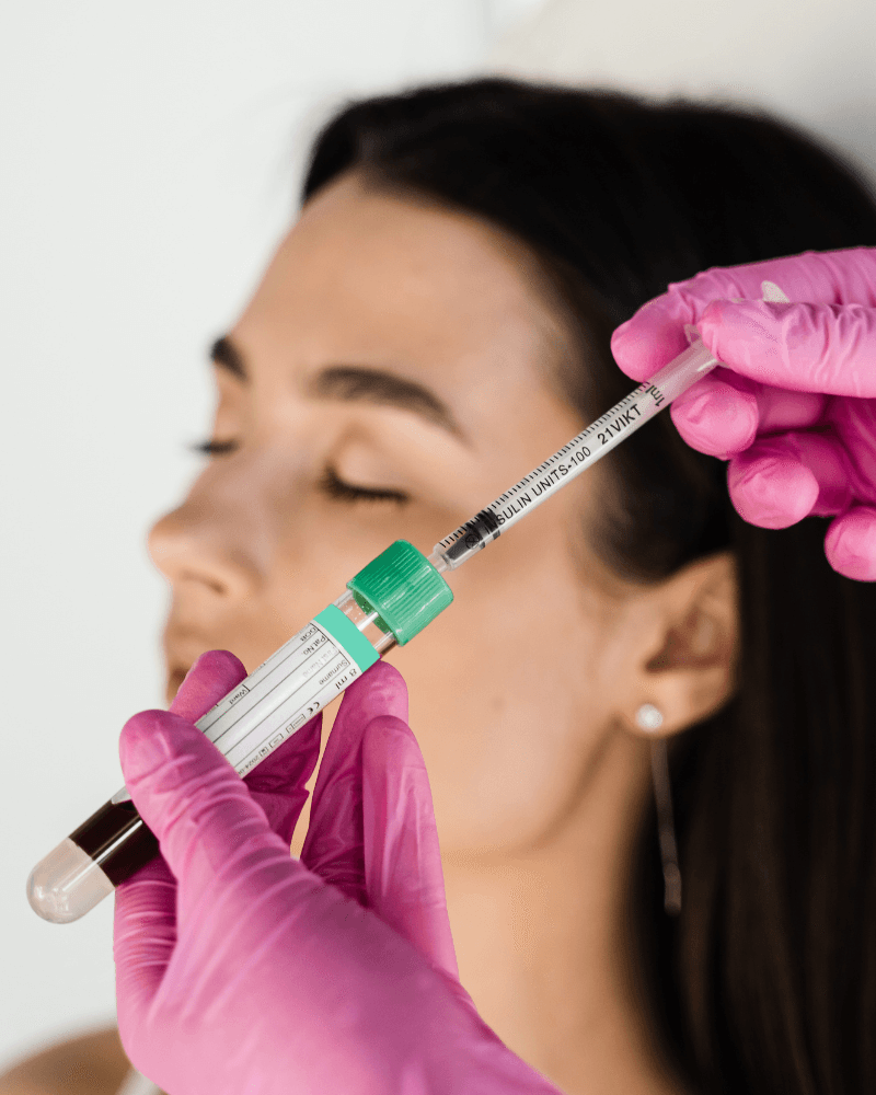 PRP is made from your own blood and placed with fine needles or cannulas where volume has thinned.